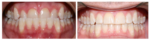 Adult male before and after Invisalign