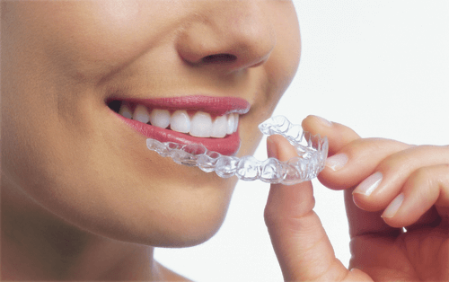 Image of woman with clear aligners