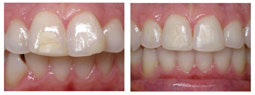 A before and after Invisalign treatment picture of a woman