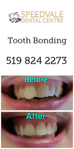 Tooth bonding banner image showing before and after pictures