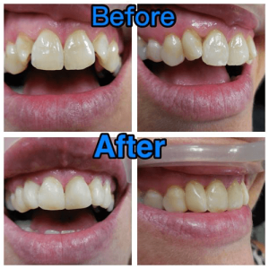Before and after picture of tooth bonding