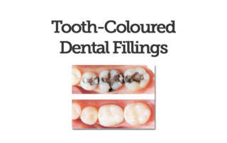 tooth coloured dental fillings